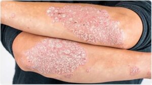 howw to cure psoriasis permanently
