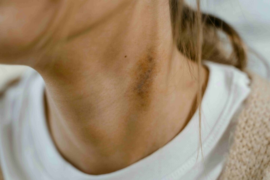 how to cure psoriasis permanently
