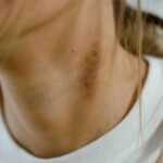 how to cure psoriasis permanently