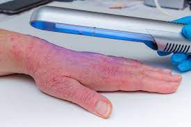 how to cure psoriasis permanently