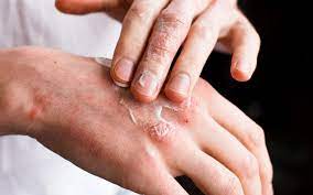 how to cure psoriasis permanently